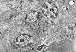 celiakia - plasmocytes in propria